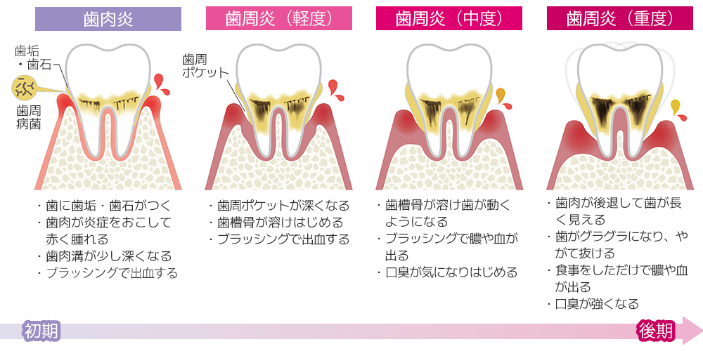 歯周病はこのように進行していきます