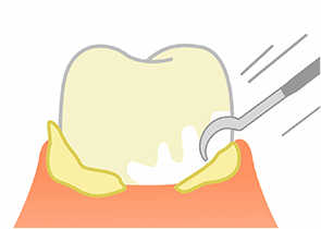歯周ポケットに潜む歯石を除去できます
